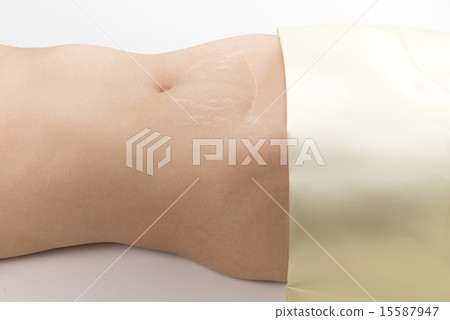 女性腹部手術疤痕 15587947