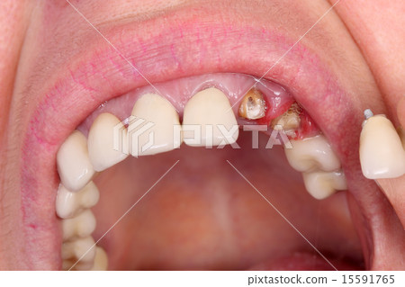 Dental, broken artificial tooth 15591765