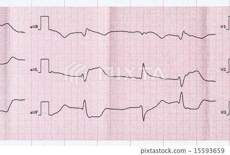 ECG with macrofocal myocardial infarction ECG with macrofocal myocardial infarction 15593659