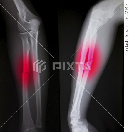 X-ray of both human arms (broken arm) X-ray of both human arms (broken arm) 15622149