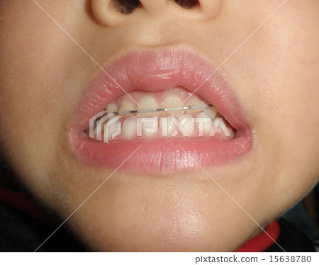 Correction of deciduous teeth 15638780