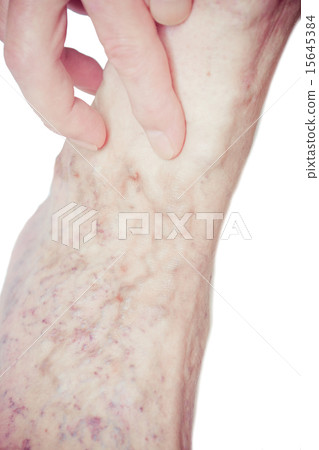 Varicose Veins on the leg 15645384