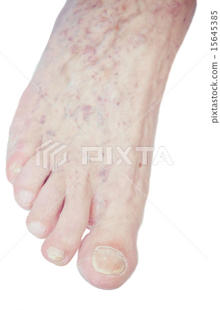Varicose Veins on the leg Varicose Veins on the leg 15645385