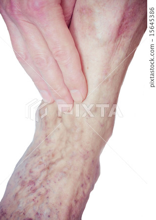 Varicose Veins on the leg Varicose Veins on the leg 15645386