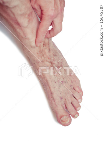 Varicose Veins on the leg Varicose Veins on the leg 15645387