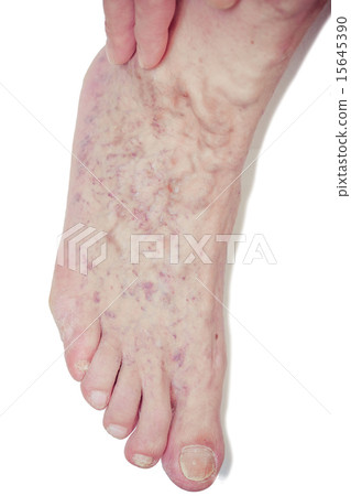 Varicose Veins on the leg Varicose Veins on the leg 15645390