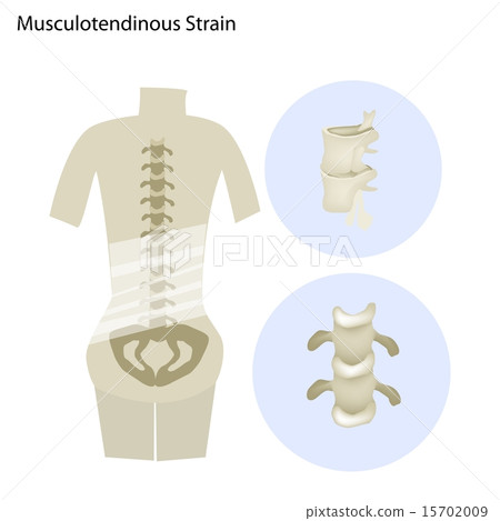 Illustration of Musculotendinous Strain Illustration of Musculotendinous Strain 15702009