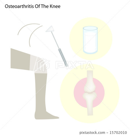 Illustration Set of Osteoarthritis of The Knee 15702010