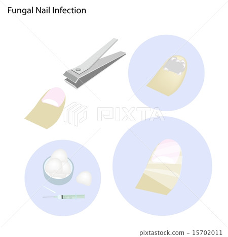 Fungal Nail Infection and Take Care 15702011