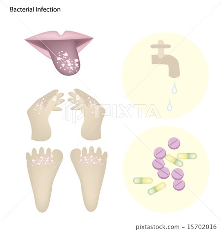 Bacterial Infection with Disease Prevention 15702016