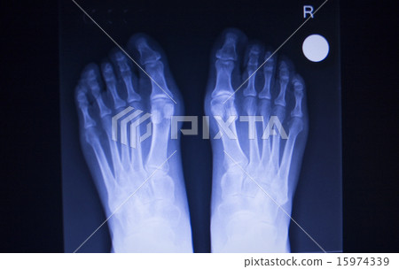 X-ray scan of foot injury anterior posterior AP X-ray scan of foot injury anterior posterior AP 15974339