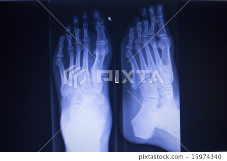 X-ray scan of foot injury anterior posterior AP 15974340