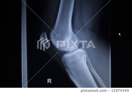 X-ray scan of painful knee meniscus leg injury X-ray scan of painful knee meniscus leg injury 15974349