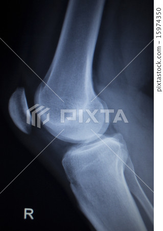 X-ray scan of painful knee meniscus leg injury X-ray scan of painful knee meniscus leg injury 15974350