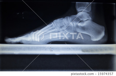 X-ray scan of foot injury load weight bearing X-ray scan of foot injury load weight bearing 15974357
