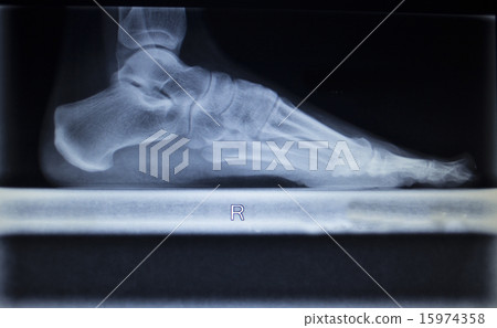 X-ray scan of foot injury load weight bearing X-ray scan of foot injury load weight bearing 15974358