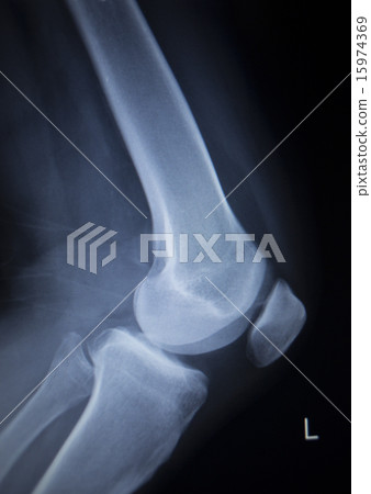 X-ray scan of painful knee meniscus leg injury X-ray scan of painful knee meniscus leg injury 15974369