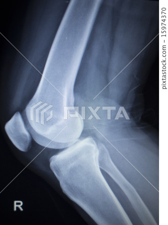 X-ray scan of painful knee meniscus leg injury X-ray scan of painful knee meniscus leg injury 15974370