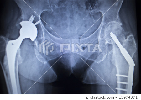 X-ray scan image of hip joint replacement implant X-ray scan image of hip joint replacement implant 15974371