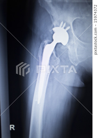 X-ray scan image of hip joint orthopedic implant X-ray scan image of hip joint orthopedic implant 15974372