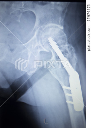 X-ray scan image of hip joint orthopedic implant X-ray scan image of hip joint orthopedic implant 15974373