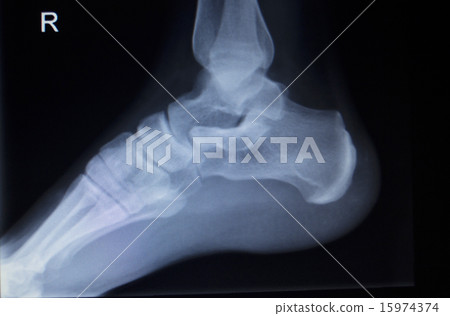 X-ray orthopedics scan of foot injury X-ray orthopedics scan of foot injury 15974374
