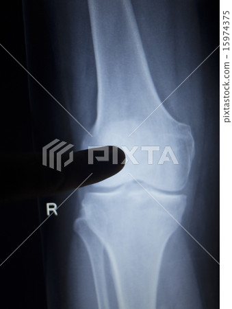 X-ray scan of painful knee meniscus leg injury X-ray scan of painful knee meniscus leg injury 15974375