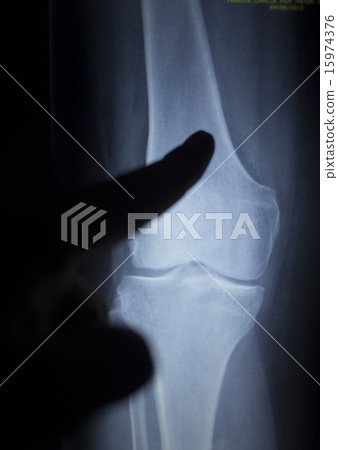 X-ray scan of painful knee meniscus leg injury X-ray scan of painful knee meniscus leg injury 15974376