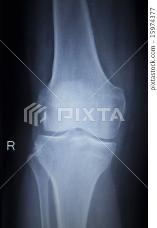 X-ray scan of painful knee meniscus leg injury X-ray scan of painful knee meniscus leg injury 15974377