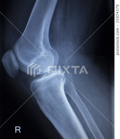 X-ray scan of painful knee meniscus leg injury X-ray scan of painful knee meniscus leg injury 15974378