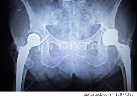 X-ray scan  image of hip joint replacement implant 15974382
