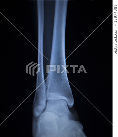 X-ray scan of painful ankle foot injury X-ray scan of painful ankle foot injury 15974389