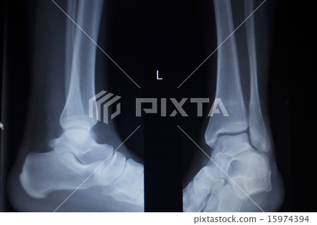 X-ray orthopedics scan painful ankle foot injury X-ray orthopedics scan painful ankle foot injury 15974394