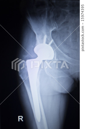 X-ray scan  image of hip joint orthopedic implant 15974395