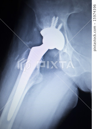 X-ray scan  image of hip joint replacement implant 15974396
