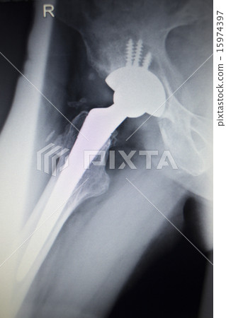 X-ray scan image of hip joint orthopedic implant X-ray scan image of hip joint orthopedic implant 15974397