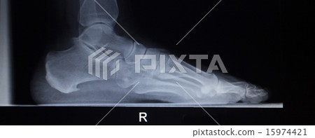 X-ray scan of foot injury load weight bearing 15974421