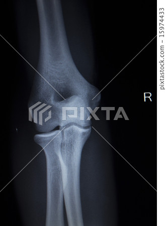 X-ray Traumatology scan of elbow joint injury X-ray Traumatology scan of elbow joint injury 15974433