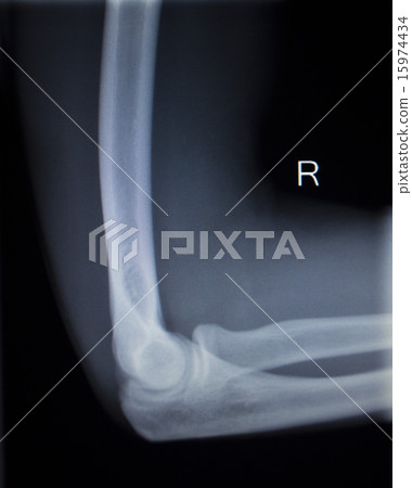 X-ray orthopedics scan of elbow joint injury 15974434