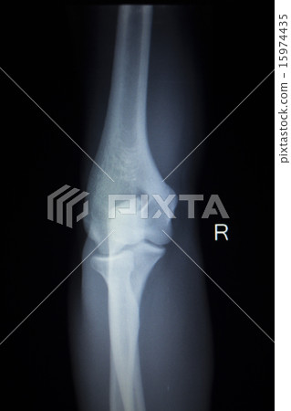 X-ray Traumatology scan of elbow joint injury 15974435