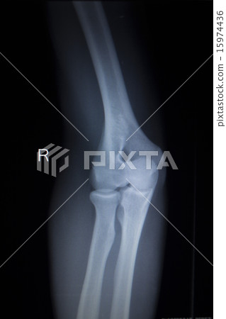 X-ray orthopedics scan of elbow joint injury 15974436