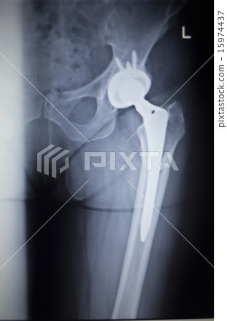 X-ray scan  image of hip joint orthopedic implant 15974437