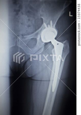 X-ray scan  image of hip joint replacement implant 15974438