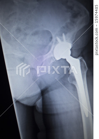 X-ray scan image of hip joint replacement implant X-ray scan image of hip joint replacement implant 15974485