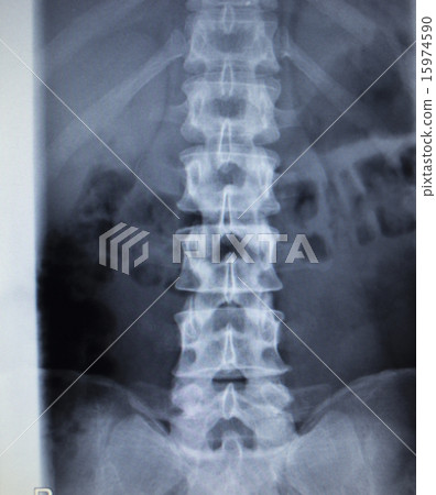 X-ray orthopedics scan back pain spine injury 15974590