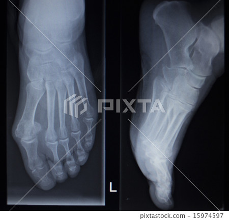 X-ray scan of foot injury anterior posterior AP 15974597