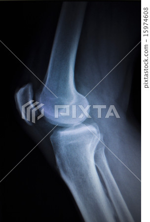 X-ray scan of painful knee meniscus leg injury X-ray scan of painful knee meniscus leg injury 15974608