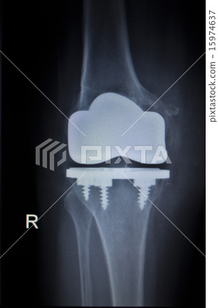 X-ray scan of knee meniscus implant prosthetics X-ray scan of knee meniscus implant prosthetics 15974637
