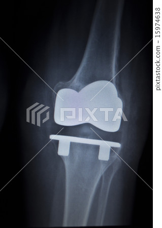 X-ray scan of knee meniscus implant prosthetics 15974638