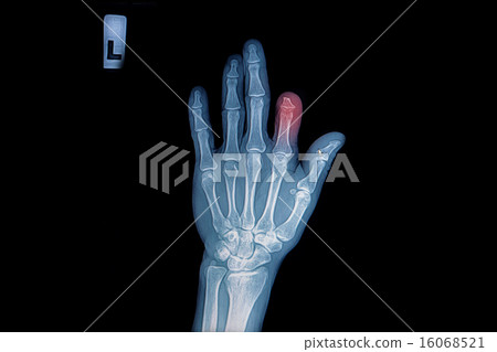 X-ray of trauma hand and finger 16068521